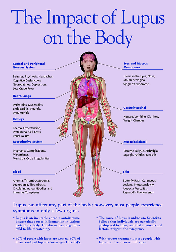 lupus headaches